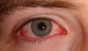 conjuntivitis